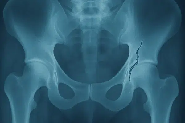 Fractura de pelvis en ancianos: causas, tratamiento y rehabilitación fisioterapéutica